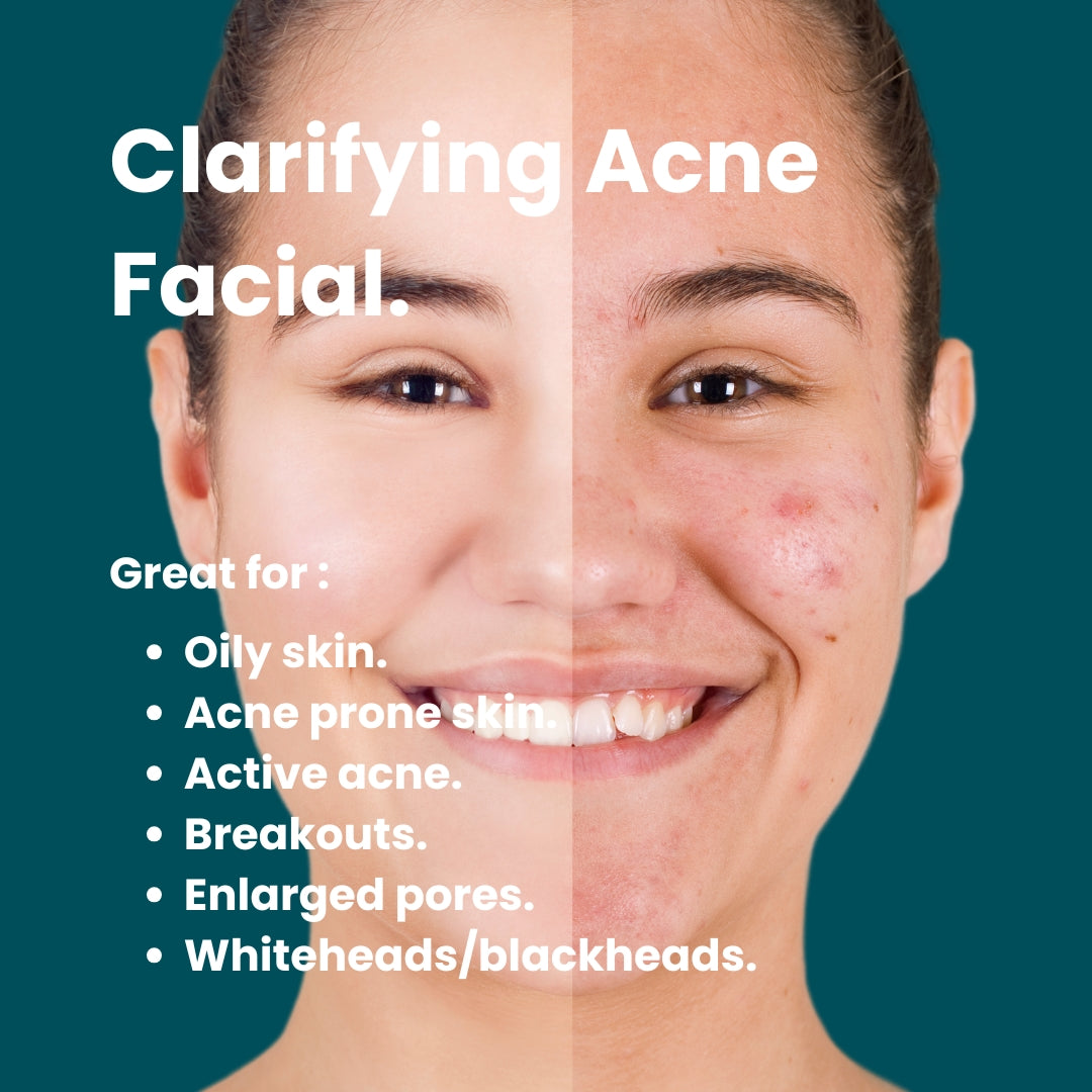 Clarifying Acne Facial