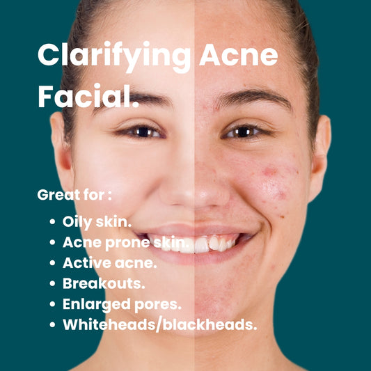 Clarifying Acne Facial